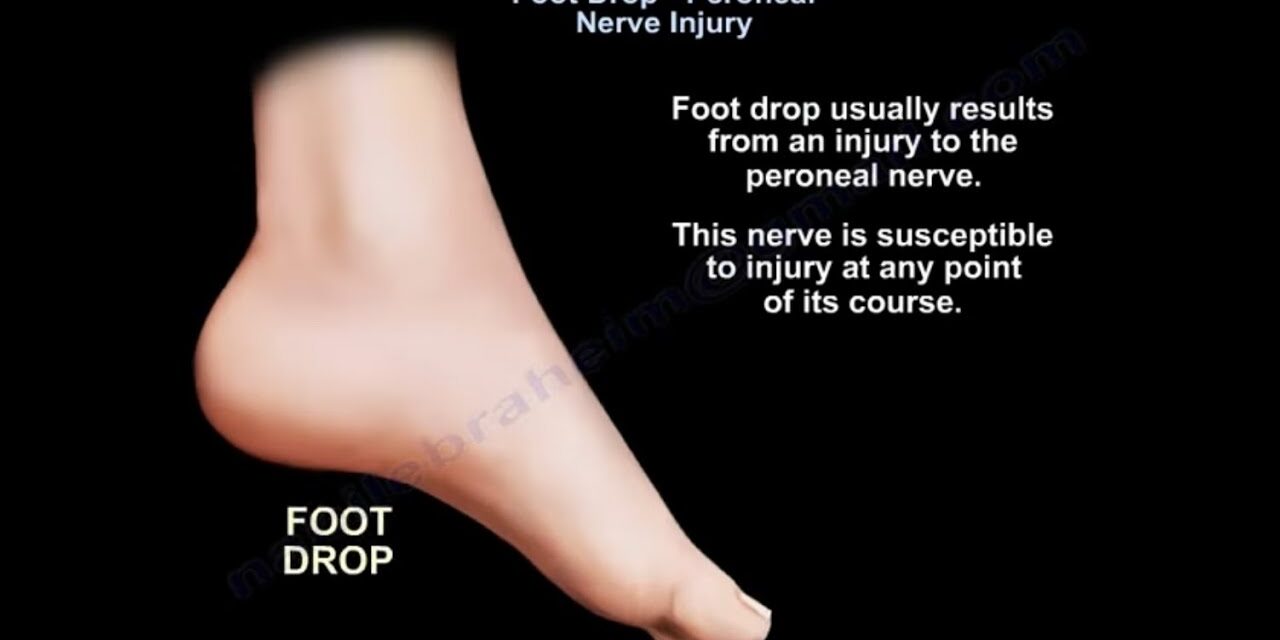 Foot Drop, peroneal nerve Injury