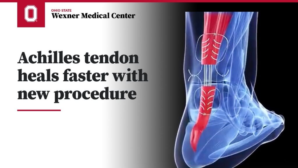 Achilles tendon heals faster with new surgical procedure | Ohio State Medical Center