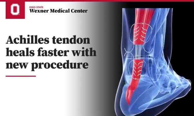 Achilles tendon heals faster with new surgical procedure | Ohio State Medical Center